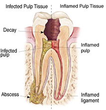 root canals explained 2