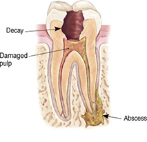 root canals explained 3
