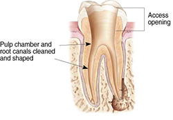 root canals explained 4