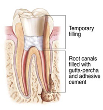 root canals explained 5