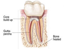 root canals explained 6