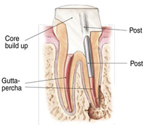 root canals explained 7