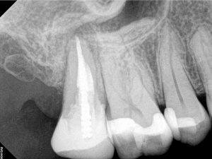 root canal XRay