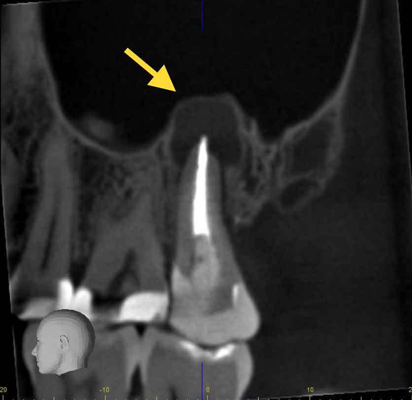 Root Canal Diagnostics Using 3D Imaging •