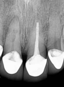 root canal XRay